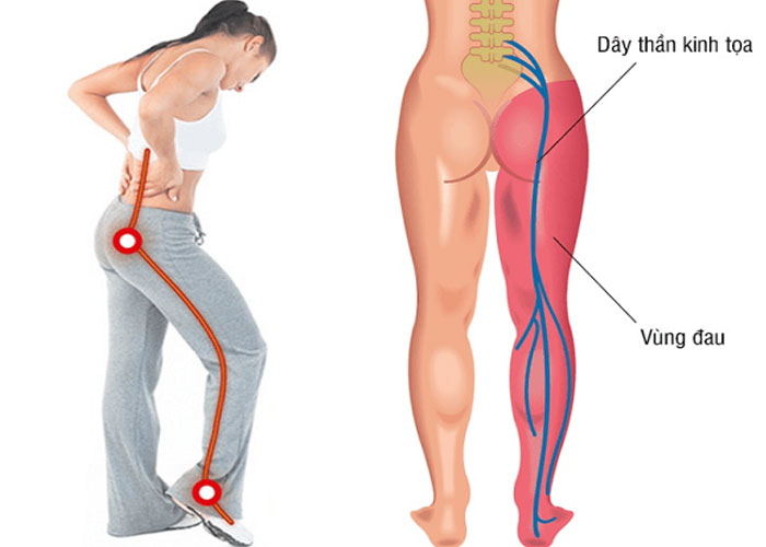 Đai lưng thảo dược có giúp giảm đau thần kinh tọa không?