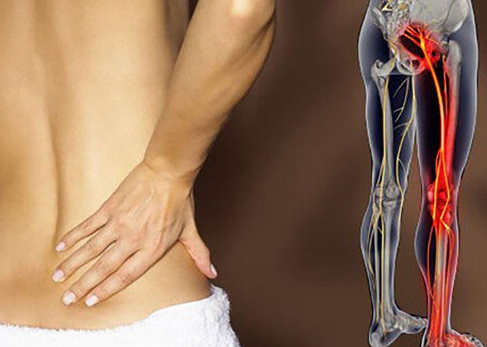 Đai lưng thảo dược có giúp giảm đau thần kinh tọa không?