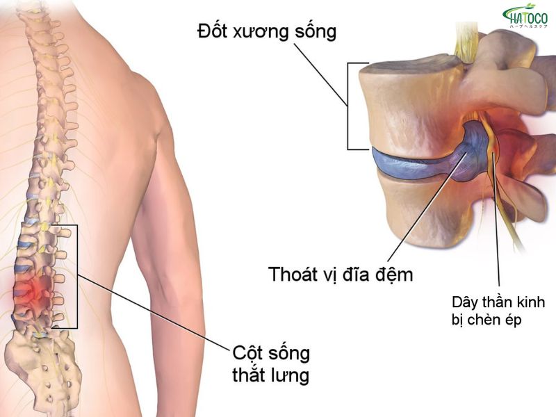 Đai lưng thảo dược có phù hợp với người thoát vị đĩa đệm không?