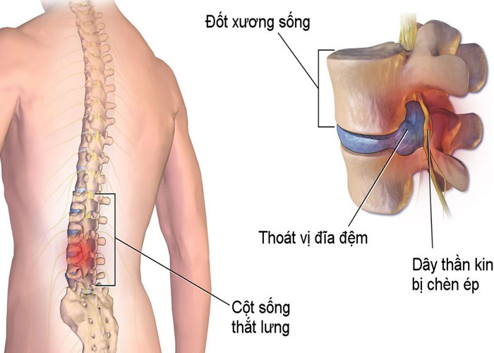 Đai lưng thảo dược dành cho người bị thoát vị đĩa đệm