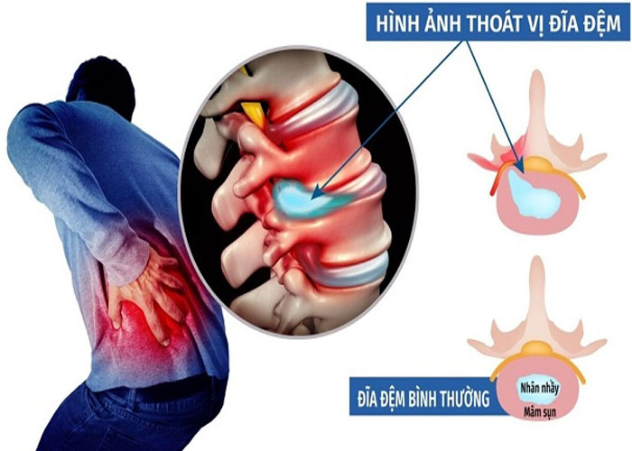Ai dễ bị thoát vị đĩa đệm nhất? Bệnh có chữa được không?