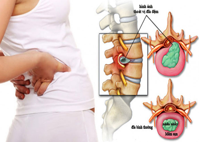 Bị thoát vị đĩa đệm nên làm gì để cải thiện tình trạng bệnh?