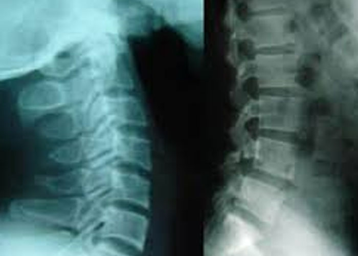 Cách chẩn đoán bệnh thoái hóa cột sống