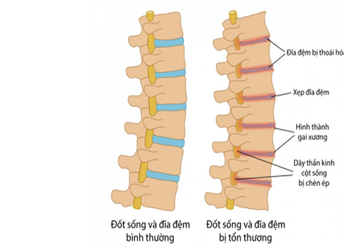 Cách chẩn đoán bệnh thoái hóa cột sống như thế nào?