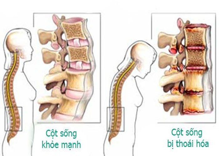 Đối tượng dễ bị thoái hóa cột sống và dấu hiệu nhận biết?