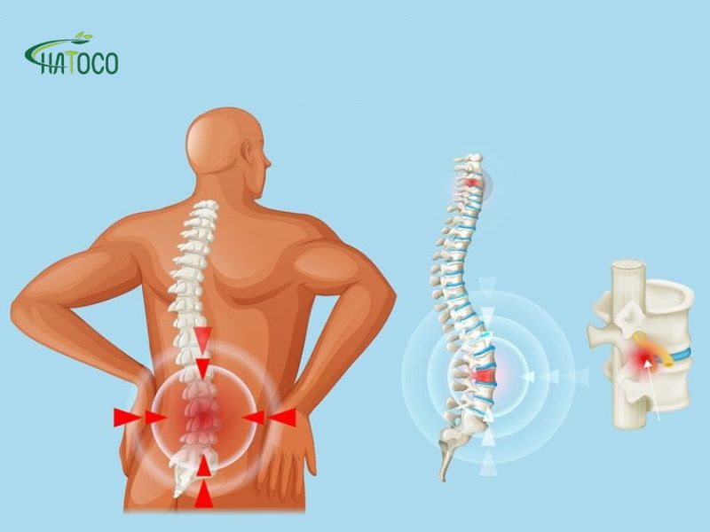 nguyen-nhan-thoat-vi-dia-dem-1