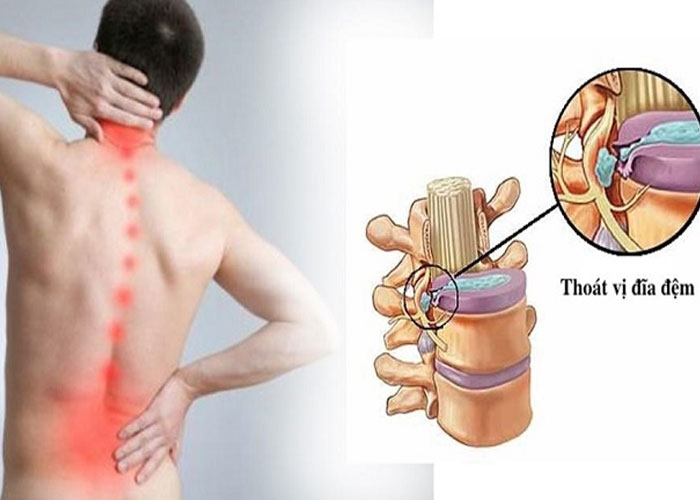 Nguyên nhân thoát vị đĩa đệm là gì? Cách phòng ngừa ra sao?