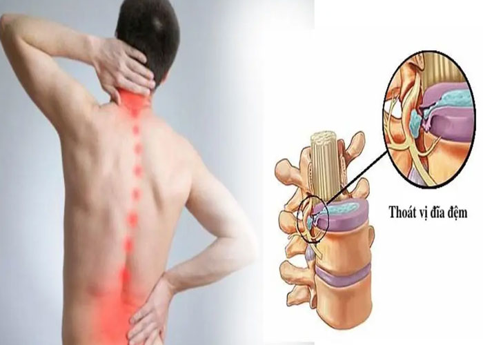 Khác biệt giữa thoái hóa cột sống và thoát vị đĩa đệm?