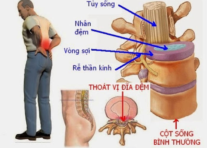 Khác biệt giữa thoái hóa cột sống và thoát vị đĩa đệm?