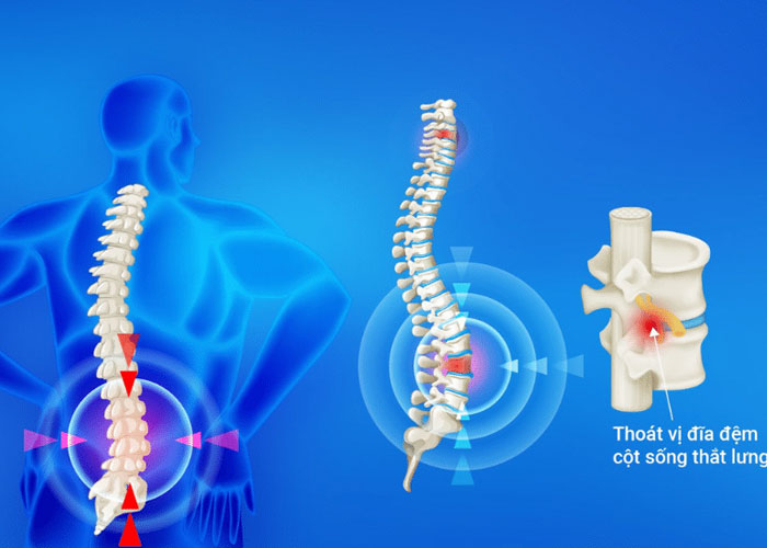 Thoát vị đĩa đệm có nguy hiểm không? Để lâu có khó chữa?