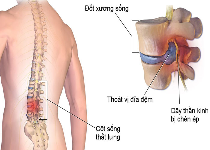 Thoát vị đĩa đệm là gì? Nguyên nhân, triệu chứng, cách điều trị