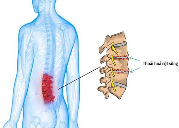 Triệu chứng thoái hóa lưng, ai dễ bị và biện pháp phòng ngừa?