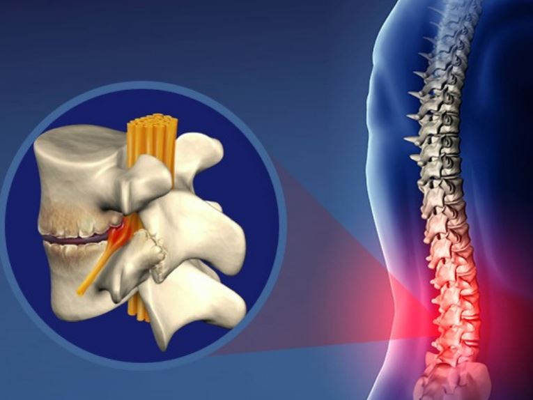 Gai cột sống có hết không? Nên điều trị bằng biện pháp nào?