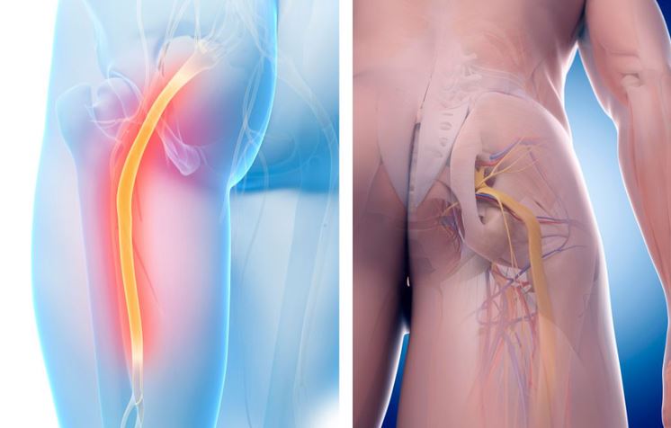 Đau thần kinh tọa là đau ở đâu? Nguyên nhân và cách điều trị?