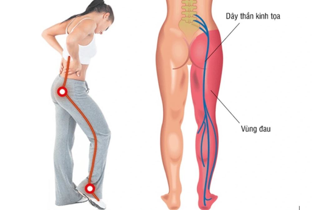 Đau thần kinh tọa là gì? Nguyên nhân, triệu chứng, cách điều trị