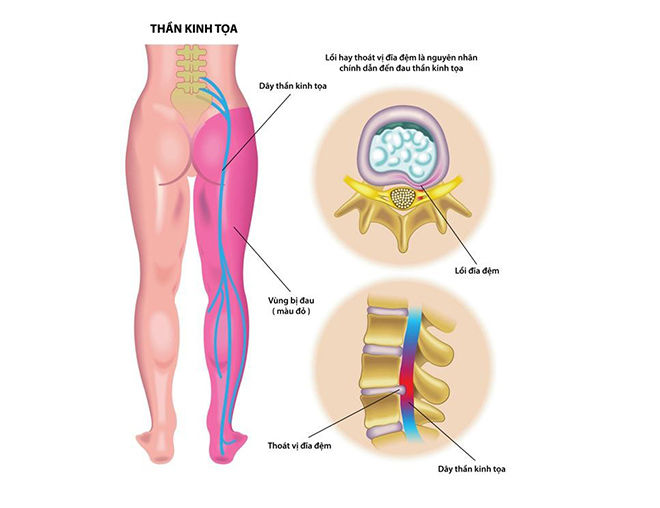 Đau thần kinh tọa uống gì để giảm đau?