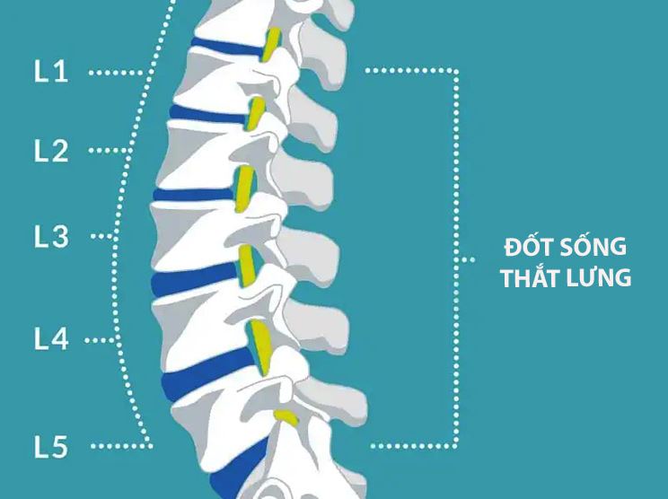 Gai cột sống L1 đến L5: Nguyên nhân và cách điều trị