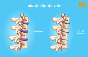 Viêm cột sống dính khớp có chữa được không?