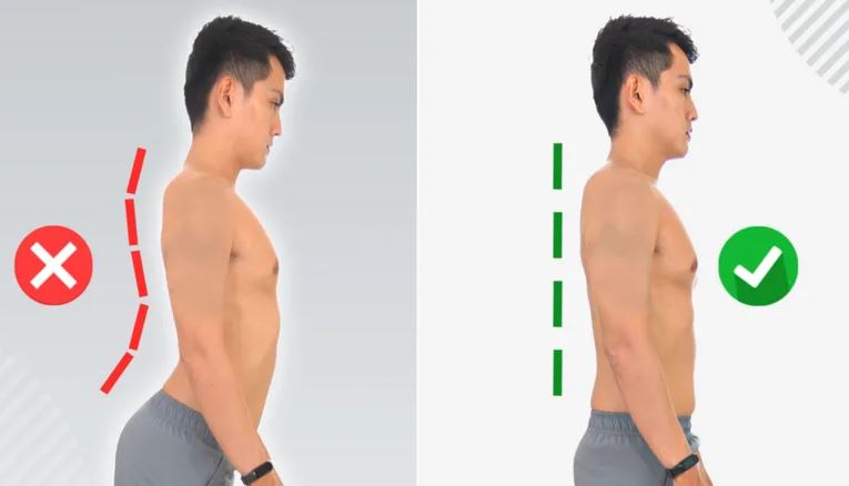 Bị võng lưng là làm sao? Nguyên nhân, dấu hiệu, cách điều trị