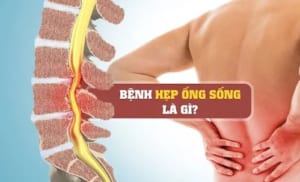 Hẹp ống sống là gì? Điều trị hẹp ống sống thắt lưng ra sao?