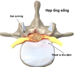 Hẹp ống sống là gì? Điều trị hẹp ống sống thắt lưng ra sao?
