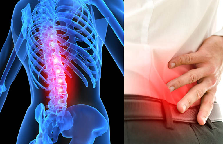 Hẹp ống sống thắt lưng có chữa được không?