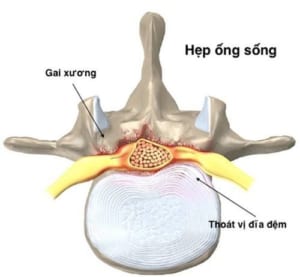 Hẹp ống sống thắt lưng có chữa được không?