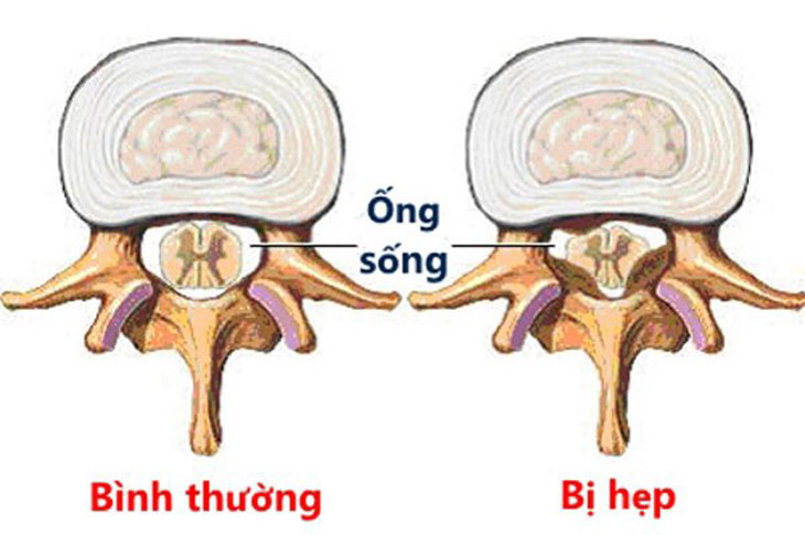 Mổ hẹp ống sống lưng sau bao lâu hết đau?