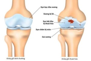 Các phương pháp điều trị thoái hóa khớp gối hiệu quả hiện nay