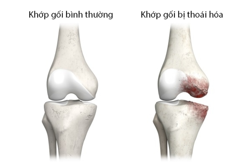 Thoái hóa khớp gối là gì? Nguyên nhân và dấu hiêu bệnh ra sao?