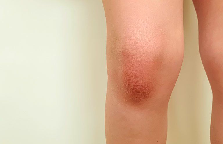 Tràn dịch khớp gối có tự khỏi được không?