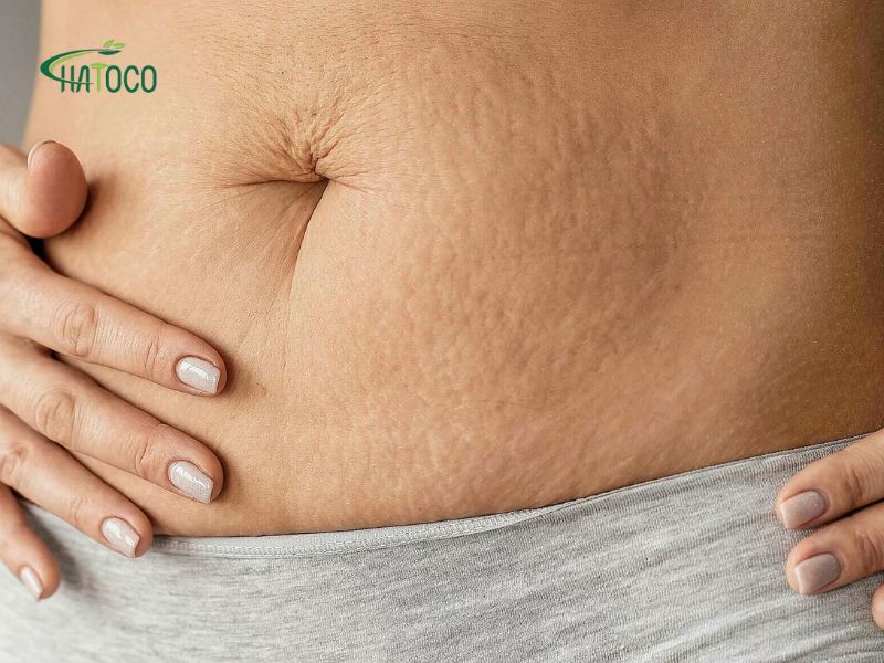 cang-co-bung-phai-lam-sao-2